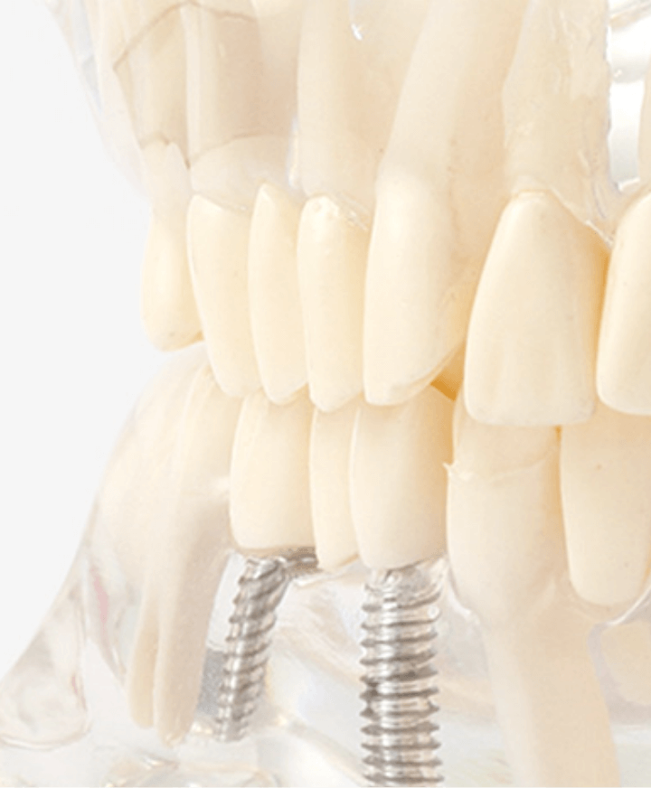 池袋の歯医者・歯科西池袋TKデンタルクリニックのインプラント治療