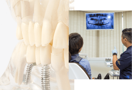 池袋の歯医者・歯科西池袋TKデンタルクリニックのインプラント治療
