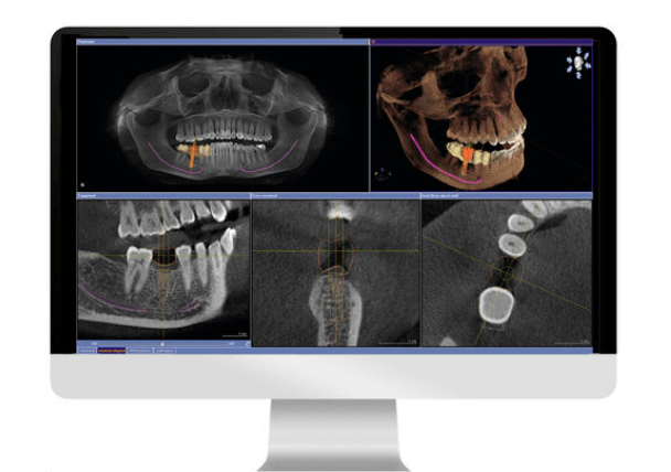 池袋の歯医者・歯科西池袋TKデンタルクリニックのインプラント治療
